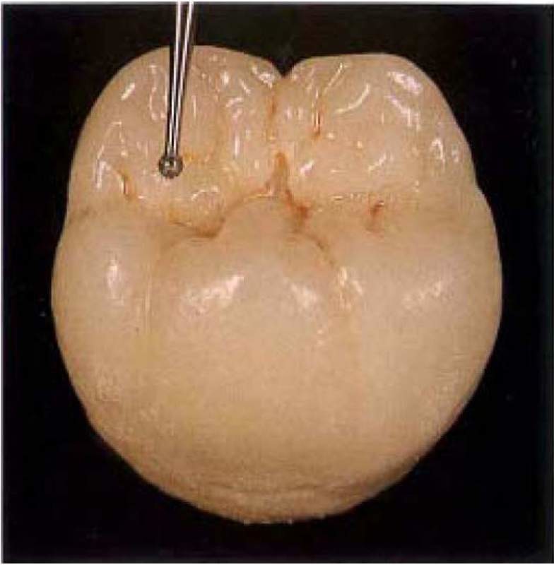 Боры стоматологические