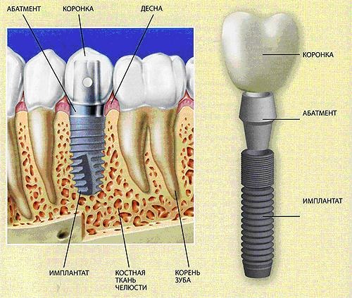Зубные имплантаты